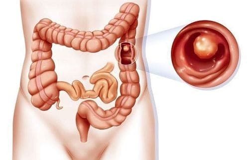 Polyp hậu môn là bệnh gì?