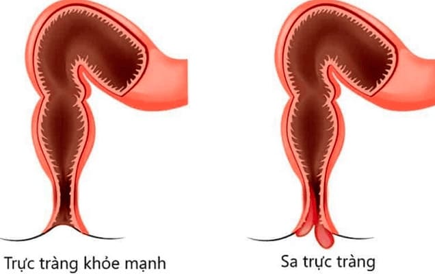 Sa trực tràng