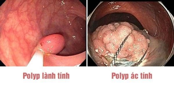 Phân biệt polyp ác tính với polyp lành tính