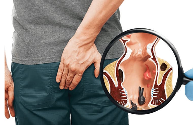 Polyp hậu môn ác tính có nguy hiểm không?