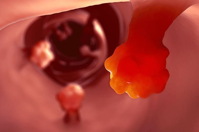 Bệnh polyp hậu môn là gì?