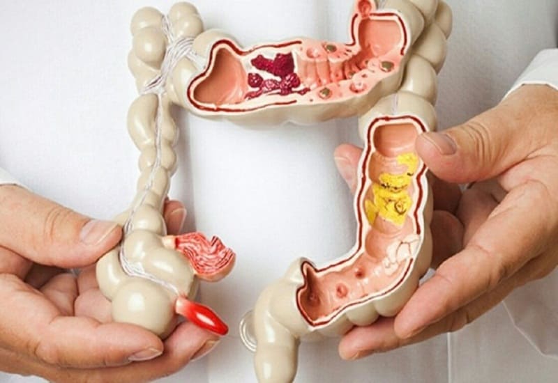 Mức độ nguy hiểm của bệnh lý polyp hậu môn