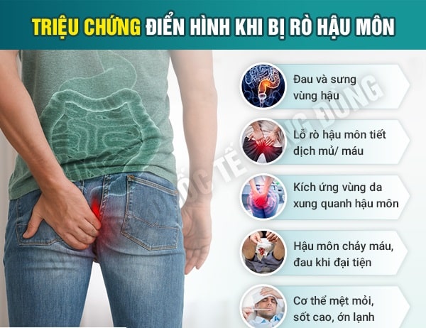 Nhận biết nhanh chóng dấu hiệu rò hậu môn điển hình