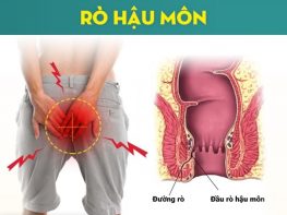 Rò hậu môn là bệnh gì ?