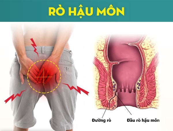 Rò hậu môn là bệnh gì ?