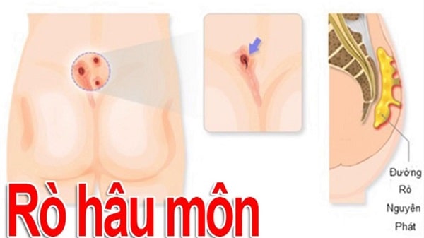 Vì sao rò hậu môn sau mổ dễ bị tái phát?