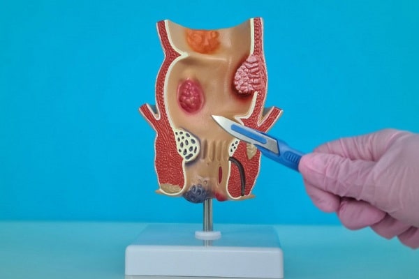 Nhận diện nhanh biến chứng rò hậu môn sau mổ?