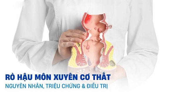Nguyên nhân gây ra rò hậu môn xuyên cơ thắt