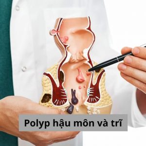 Polyp hậu môn và trĩ