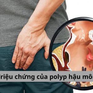 Triệu chứng của polyp hậu môn
