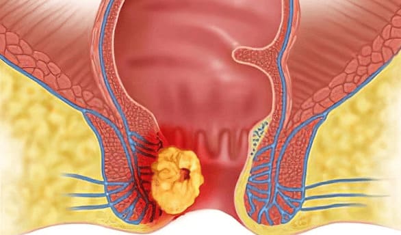 Ung thư là biến chứng polyp hậu môn nguy hiểm nhất
