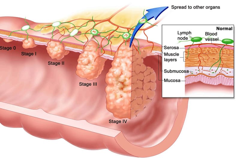 Quá trình polyp hậu môn tiến triển thành ung thư