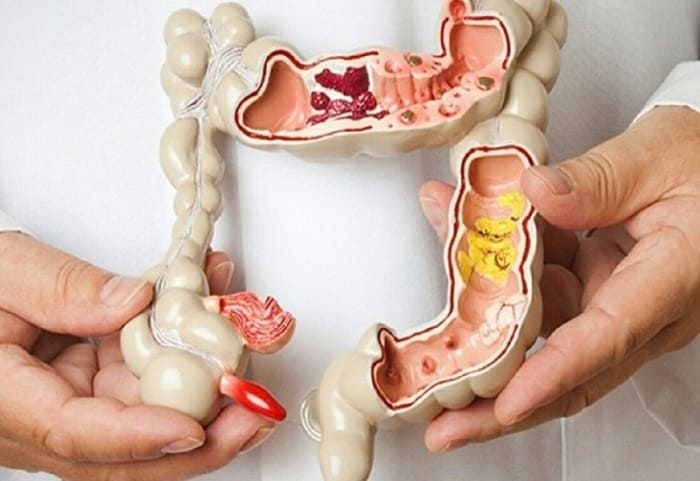 Các biến chứng polyp hậu môn