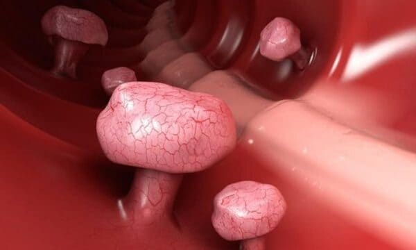 Căn bệnh polyp hậu môn