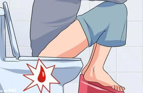 Biểu hiện polyp hậu môn: Đại tiện ra máu
