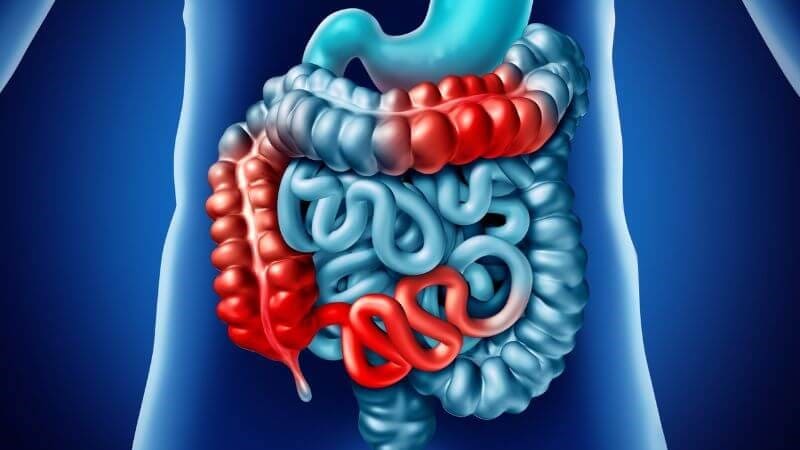 Biểu hiện polyp hậu môn: Đau bụng do tắc ruột