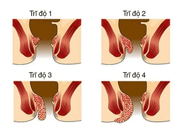 Tổng quan và phân loại bệnh trĩ