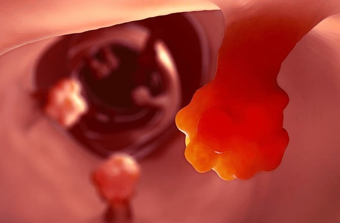 Bệnh Polyp hậu môn là gì?