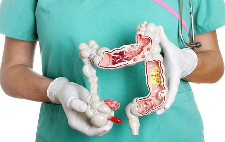 Cắt polyp hậu môn để ngăn ngừa biến chứng