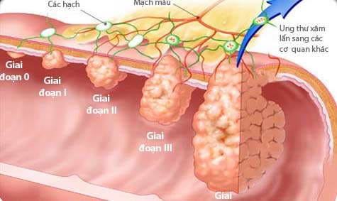 Chi phí chữa polyp hậu môn phụ thuộc vào tình trạng bệnh