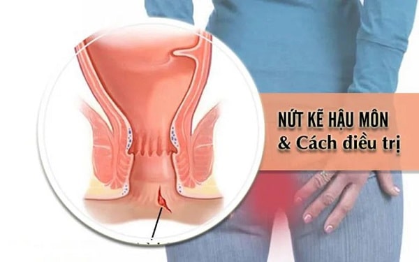 Nứt kẽ hậu môn và những thông tin cần biết