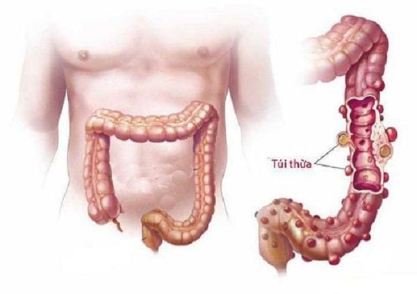 Bệnh viêm túi thừa