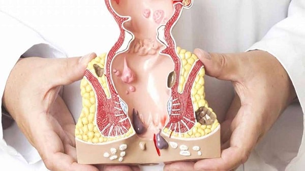 Bạn đã hiểu rõ quy trình điều trị nứt kẽ hậu môn chưa?
