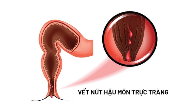 Cập nhật chung về bệnh lý nứt kẽ hậu môn