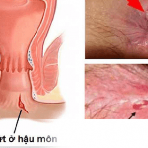 Vì sao nhiều người bị nứt kẽ hậu môn?