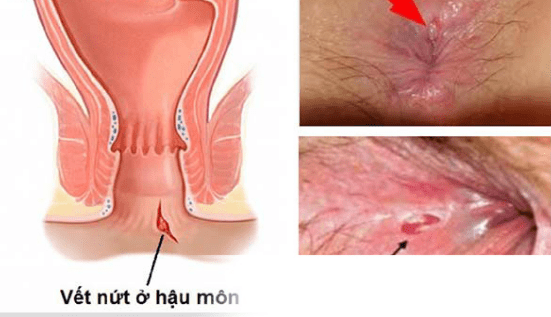 Vì sao nhiều người bị nứt kẽ hậu môn?