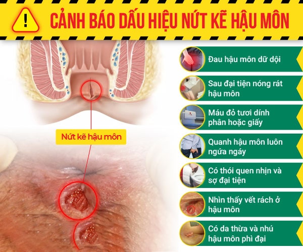 Bị nứt kẽ hậu môn có thể gây ra nguy hiểm không ?