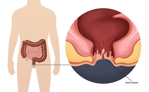 Nắm rõ triệu chứng để biết nứt kẽ hậu môn có gây ung thư không