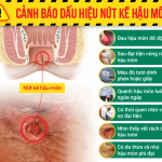 Nứt kẽ hậu môn có gây ung thư không?