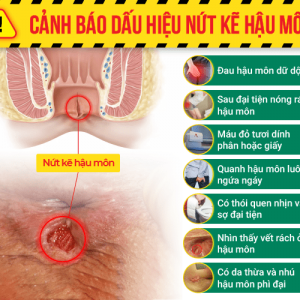 Nứt kẽ hậu môn có gây ung thư không?
