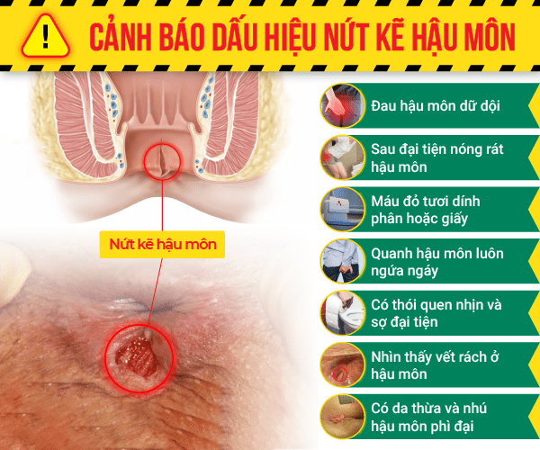 Nứt kẽ hậu môn có gây ung thư không?