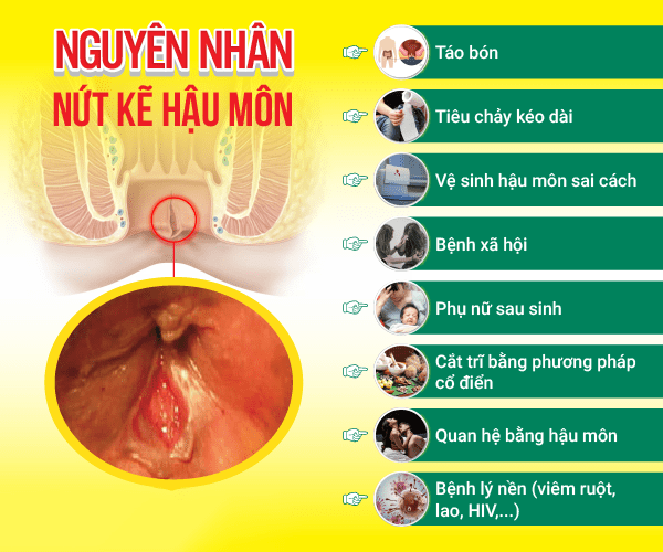 Tìm hiểu nguyên nhân để biết nứt kẽ hậu môn có gây ung thư không