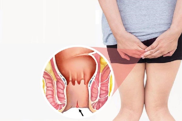 Nứt kẽ hậu môn là bệnh gì ?