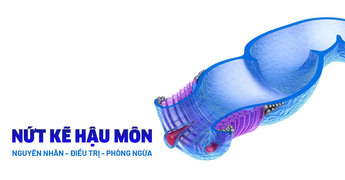 Tìm hiểu 1 số thông tin chung về bệnh nứt kẽ hậu môn
