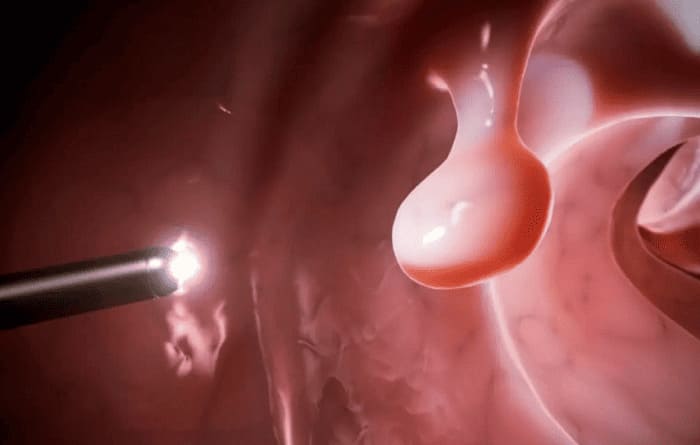Polyp hậu môn