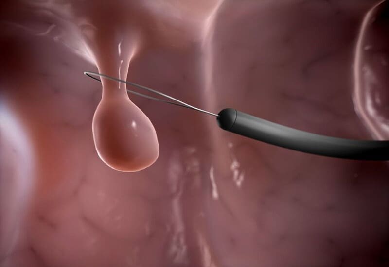 Bệnh polyp hậu môn là gì?