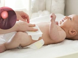 Trẻ sơ sinh bị polyp hậu môn