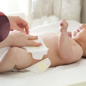 Trẻ sơ sinh bị polyp hậu môn