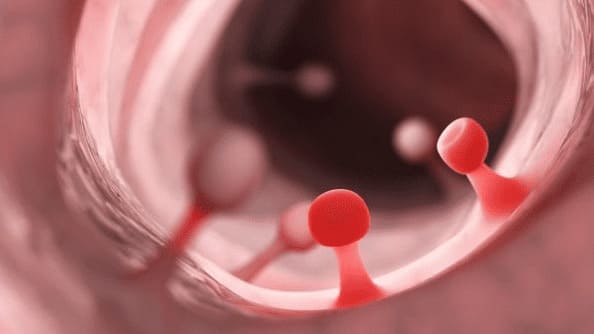 Tìm hiểu chung về bệnh polyp hậu môn