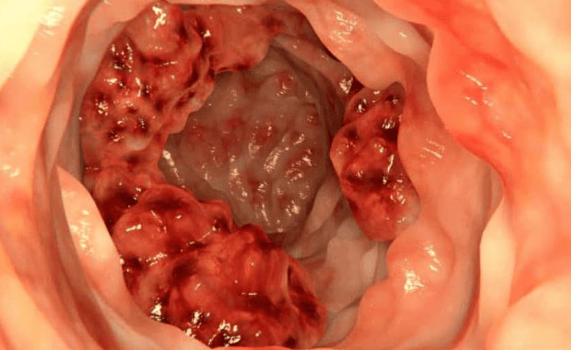 Mức độ nguy hiểm của polyp hậu môn bạn chớ nên coi thường!