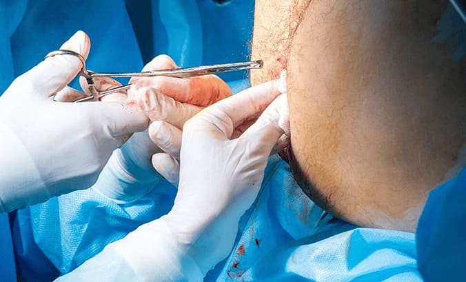 Cập nhật quy trình cắt polyp hậu môn chuẩn y khoa