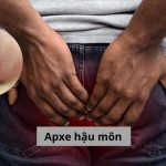 Apxe hậu môn