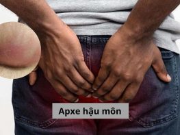 Apxe hậu môn