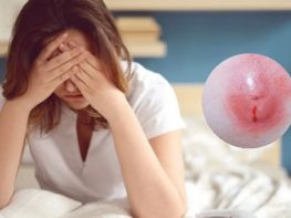 Cách chữa áp xe hậu môn tại nhà