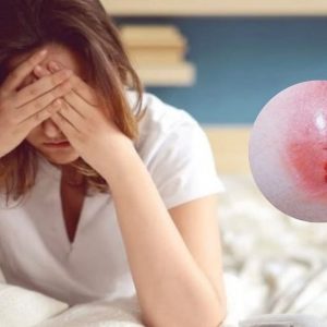 Cách chữa áp xe hậu môn tại nhà