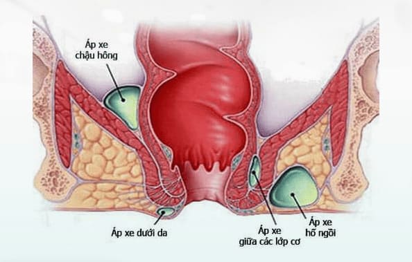 Vì sao có nhiều người gặp nguy hiểm do áp xe hậu môn